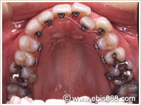 リンガル矯正(裏側矯正・舌側矯正)短期間矯正治療例装置装着時