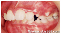 小児矯正 上顎前突治療例初診