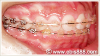 小児矯正 上顎前突治療例治療中